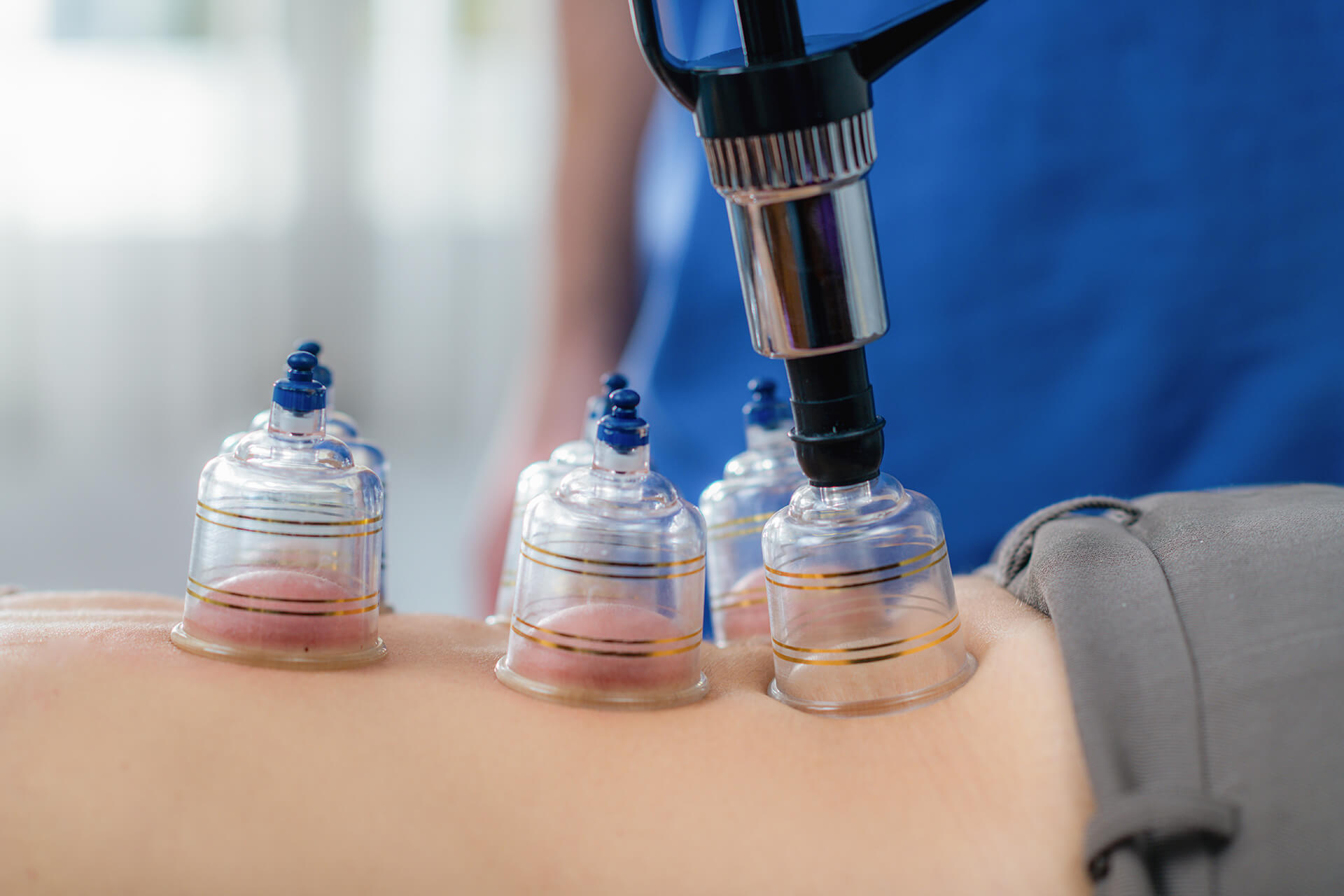 Hijama Zaandam - Cupping therapie